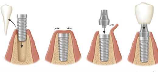 cum se face un implant dentar